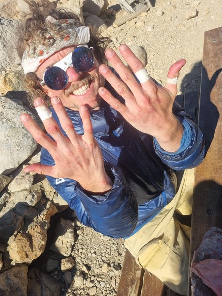 Sondres fingre, Ăždelagt etter Sifuentes-Monti